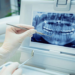 Dental Extractions
