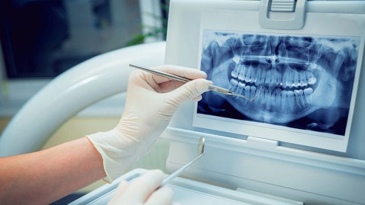 Dental Extractions