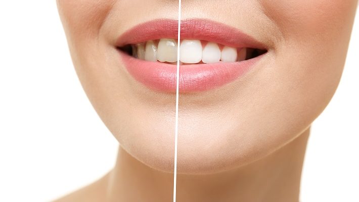 Teeth Whitening in Lewis Center
